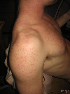 Spotty back from steroids